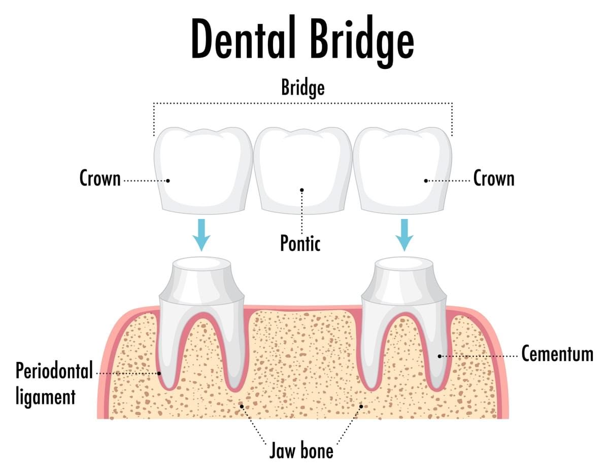 Dental Bridge Anatomy – Crowns and Bridges Procedure Diagram at Oakville Dental Crowns and bridges diagram illustrating pontic placement between abutment crowns at Oakville Dental