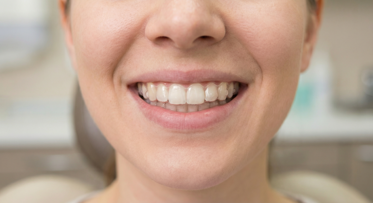 Patient wearing clear Invisalign aligners during orthodontic treatment at Oakville Dental