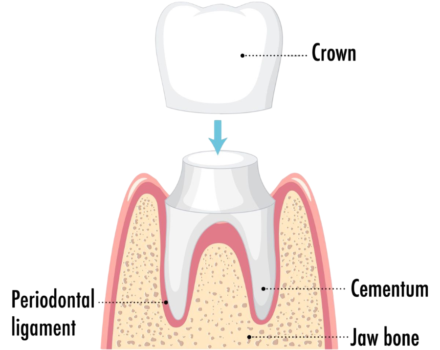 Same-day crown procedure in Oakville – anatomical diagram showing a porcelain crown being placed over a prepared tooth at Oakville Dental