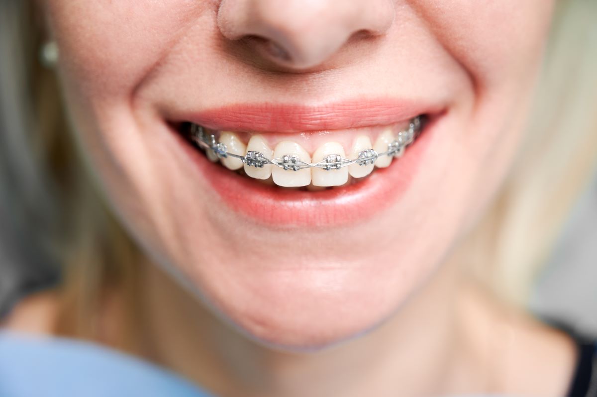 Traditional Metal Braces in Oakville, ON – Oakville Dental Orthodontic Treatment Close-up of traditional metal braces on teeth at Oakville Dental, showing precision bracket and wire placement for orthodontic alignment